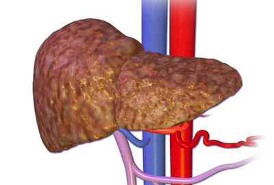 Вірусний цироз печінки: що це таке, його причини і лікування