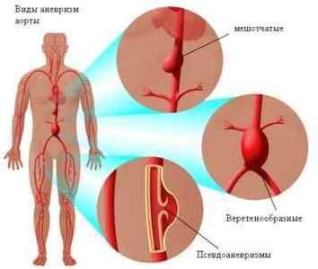Вісцеральний сифіліс: причини, симптоми, лікування