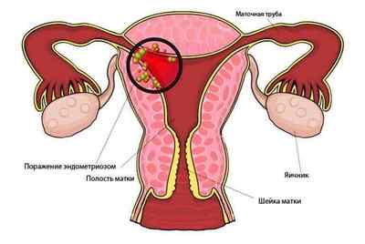 Все про ендометріоз матки - причини, симптоми, способи лікування