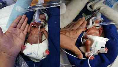 Встановлено світовий рекорд вижили недоношених близнюків