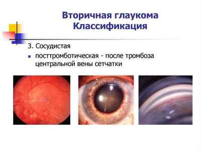 Вторинна глаукома (неоваскулярная, факсогенная): лікування, чи є можливість відновити зір