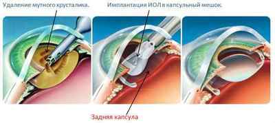 Вторинна катаракта після заміни кришталика: лікування, симптоми, протипоказання лазерної дісцізія