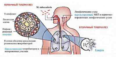 Вторинний туберкульоз: причини розвитку, симптоми, лікування