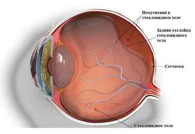 Вітректомія: операція по видаленню склоподібного тіла ока