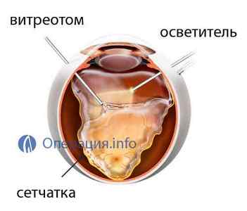 Вітректомія: операція по видаленню склоподібного тіла ока