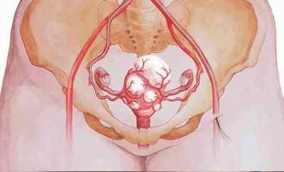 Вузлова міома матки: причини, лікування, симптоми