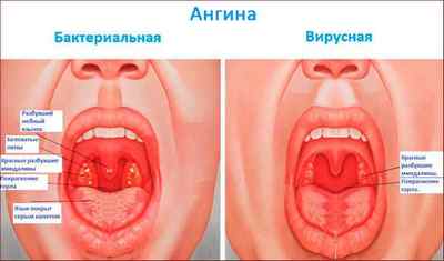 Які бувають інфекції горла, їх симптоми і лікування
