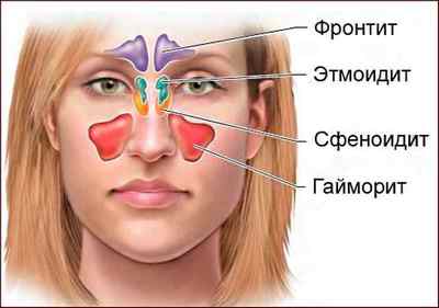 Як і чим лікувати сильний нежить і закладеність носа