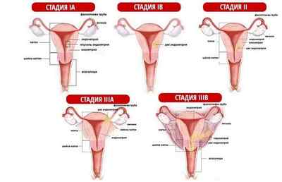 Як діагностувати і визначити наявність раку ендометрія у жінок