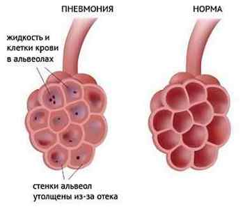 Які хрипи при пневмонії і що вони можуть означати