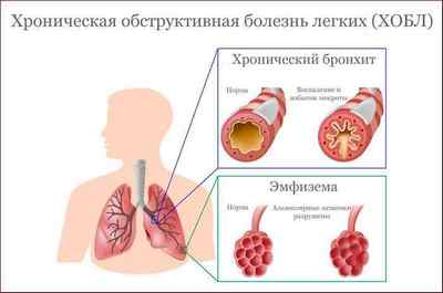 Які хвороби легень бувають у людини, їх ознаки і симптоми