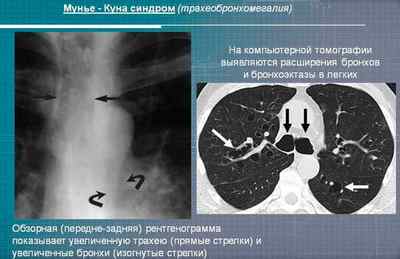 Які хвороби легень бувають у людини, їх ознаки і симптоми