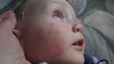 Як лікувати алергію на холод у дитини
