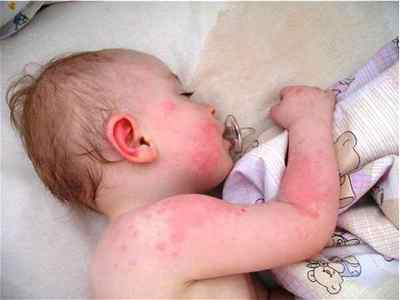 Як лікувати алергію на холод у дитини