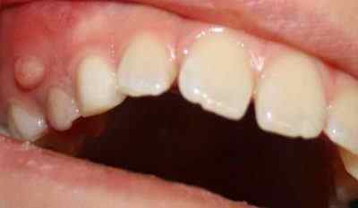Як лікувати фурункул на яснах в роті? Симптоми і запобіжні заходи