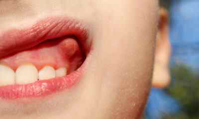 Як лікувати фурункул на яснах в роті? Симптоми і запобіжні заходи