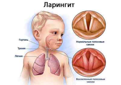 Як лікувати сухий дратівливий кашель у дитини і дорослого