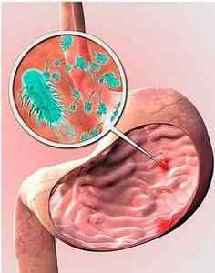 Як передається гастрит: мікроби, що викликають запалення слизової шлунка