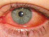 Як передається очної конюнктивіт у дітей і дорослих, шляхи передачі (повітряно-крапельний, інфекційний)
