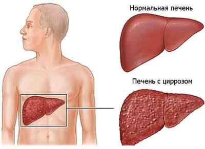 Які показники крові вказують на цироз печінки