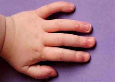 Як позбутися від бородавок у дітей на пальцях в домашніх умовах? Фото наростів на руках і ногах