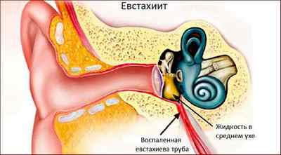 Як позбутися від закладеності вуха: різні засоби і препарати