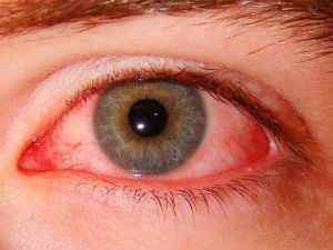 Як прибрати червоність очей, способи швидко позбутися від почервоніння