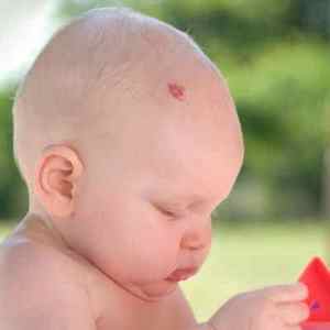 Які причини розвитку невусів у малюків або коли зявляються родимки у новонароджених?