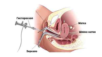 Як проводиться гістерорезектоскопія міоми матки