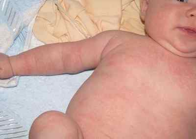 Як проявляється алергія на антибіотики - висип на шкірі, лікування