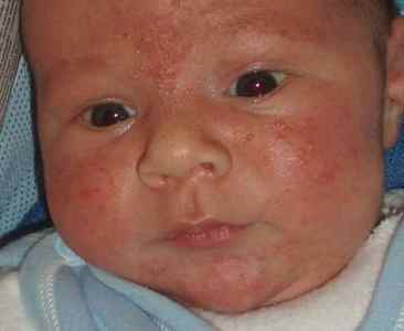 Як проявляється алергія на молоко у дитини: фото