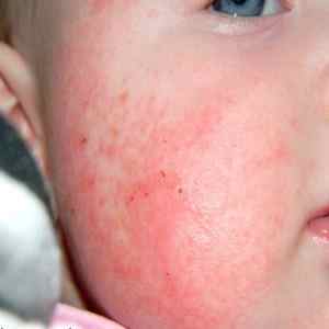 Як проявляється алергія на вітамін Д?