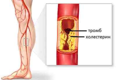 Як робити профілактику тромбозу судин
