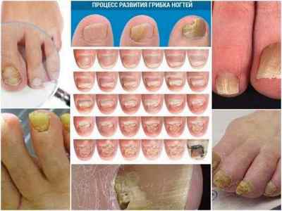 Як розпізнати грибок нігтів на ногах - ознаки і відмінності від інших захворювань