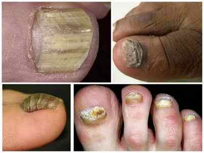 Як розпізнати грибок нігтів на ногах - ознаки і відмінності від інших захворювань