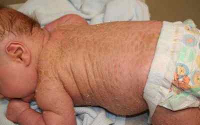 Як розпізнати псоріаз у немовлят: фото перших симптомів у новонароджених. Чим захворювання небезпечне для немовлят?