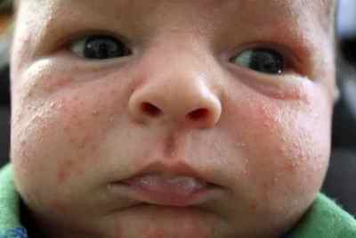 Як розпізнати псоріаз у немовлят: фото перших симптомів у новонароджених. Чим захворювання небезпечне для немовлят?