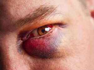 Як швидко вилікувати синяк під оком, лікування гематоми після удару в домашніх умовах