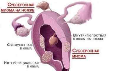 Які симптоми і ознаки вкажуть на те, що це міома матки?