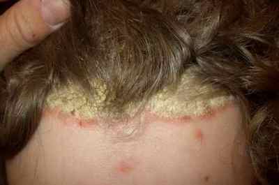 Які симптоми псоріазу на шкірі і як починають прогресувати види цього захворювання?