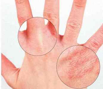 Які симптоми псоріазу на шкірі і як починають прогресувати види цього захворювання?