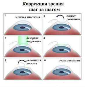 Як відновити зір при короткозорості: як лікувати, лікування народними засобами в домашніх умовах