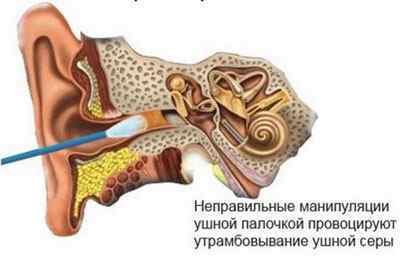 Як видалити сірчані пробки в вухах за допомогою перекису водню