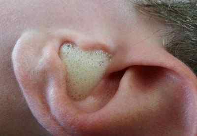 Як видалити сірчані пробки в вухах за допомогою перекису водню