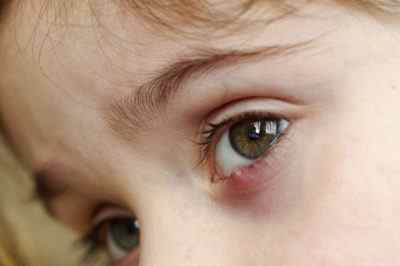 Як виглядає чиряк на оці у дитини, а також лікування та заходи профілактики його виникнення