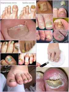 Як виглядає грибок нігтів на ногах - фото і опис симптомів
