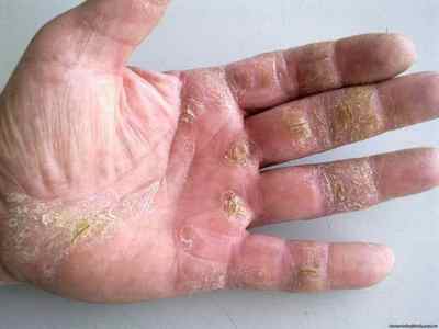 Як виглядає псоріаз на пальцях рук: фото проявів на шкірі і нігтях