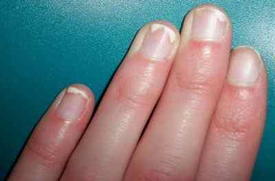 Як виглядає псоріаз нігтів на фото і як відрізнити це захворювання від грибка? Симптоми і лікування