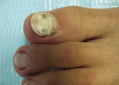Як виглядає псоріаз нігтів на фото і як відрізнити це захворювання від грибка? Симптоми і лікування