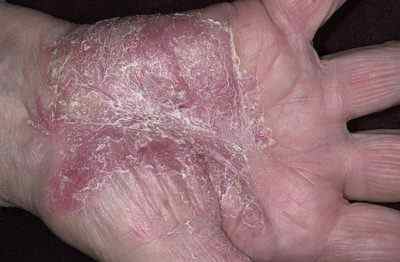 Як виглядає псоріаз рук на фото? Симптоми і причини виникнення захворювання шкіри рук